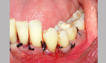 Cosmetic dentistry treatment in Anand
                        